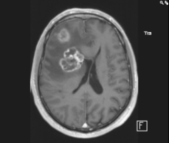 MRT-Aufnahme vom Kopf eines Patienten. Der Tumor im linken Teil des Gehirns ist deutlich erkennbar.
